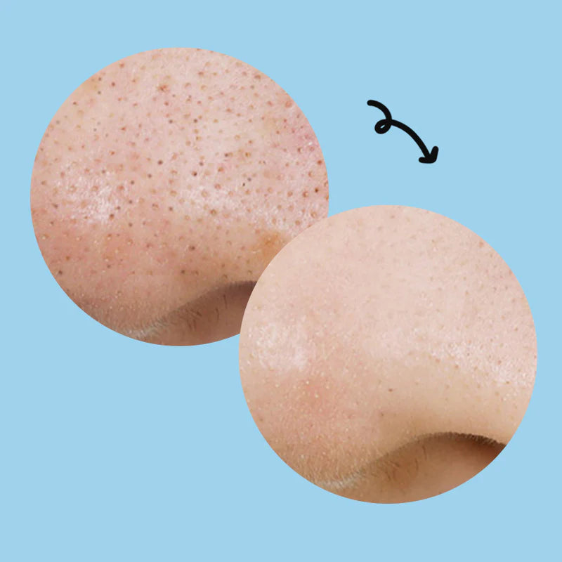 MANYO Blackhead Kill Pad, Korean Beauty